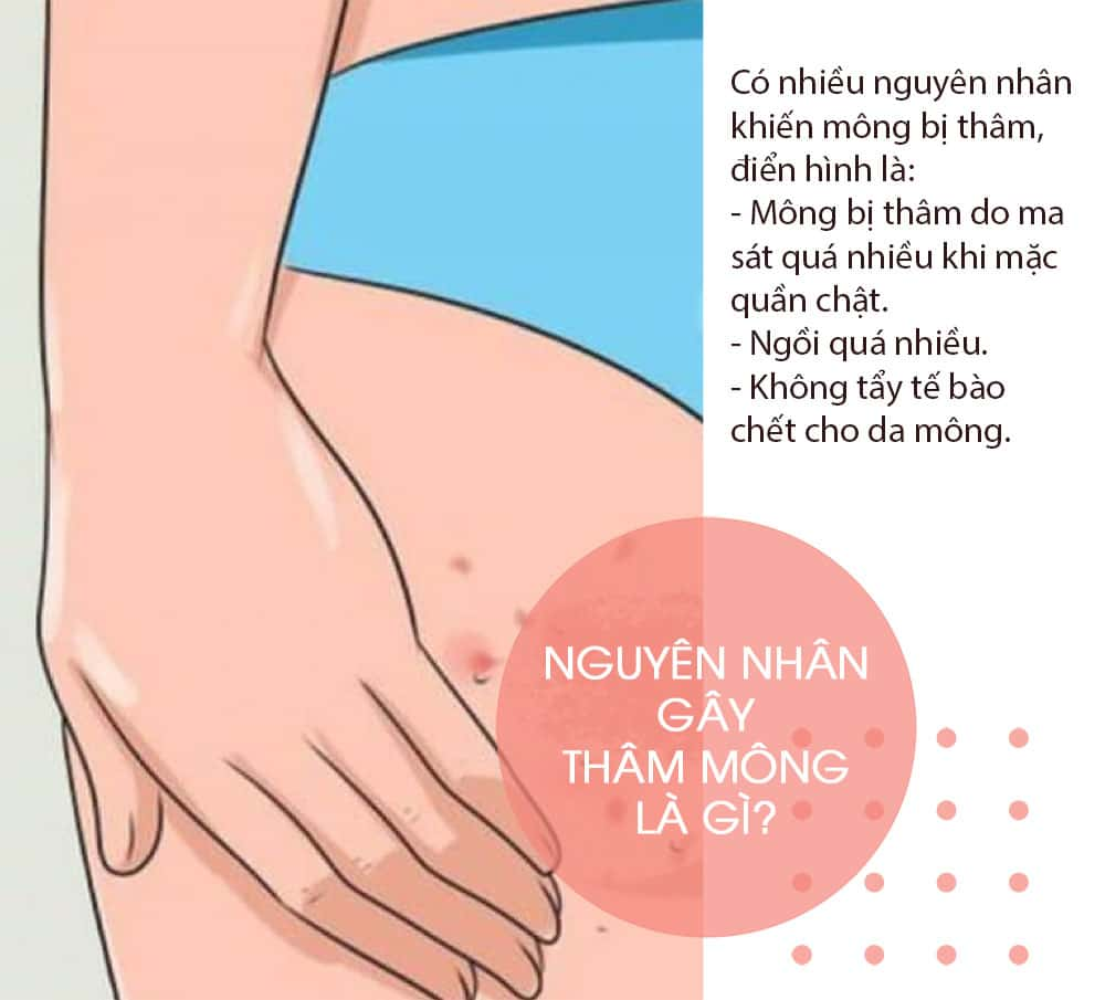 Mông Bị Thâm: Nguyên Nhân, Cách Khắc Phục Và Chăm Sóc Da Hiệu Quả